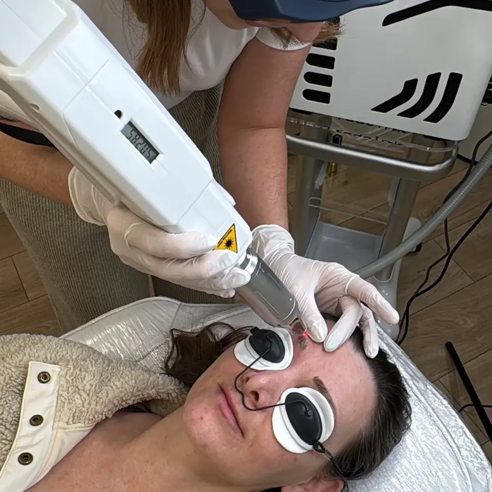Tattoo being removed with a laser tattoo removal machine
