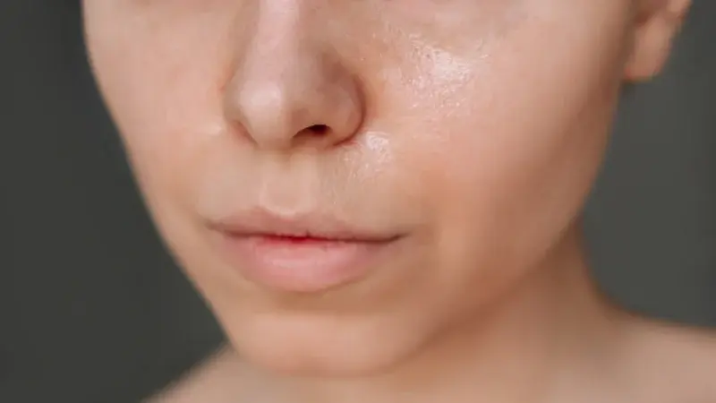 A woman with oily skin